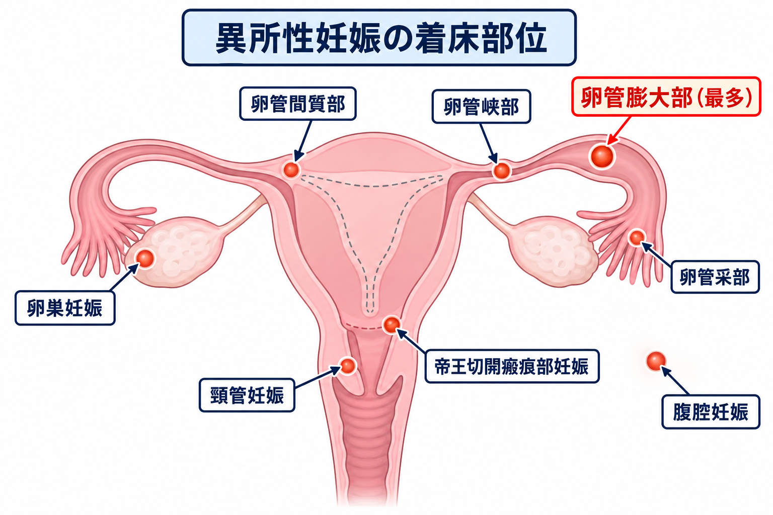 異所性妊娠の着床部位