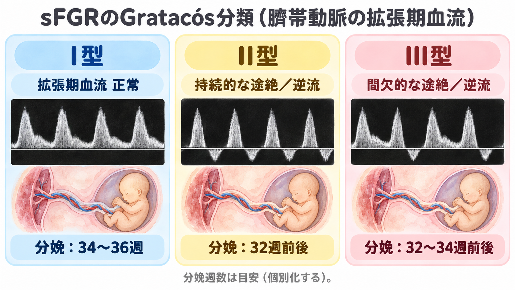 sFGRのGratacós分類（臍帯動脈の拡張期血流）：I型は正常（分娩34〜36週）、II型は持続的な途絶／逆流（32週前後）、III型は間欠的な途絶／逆流（32〜34週前後）
